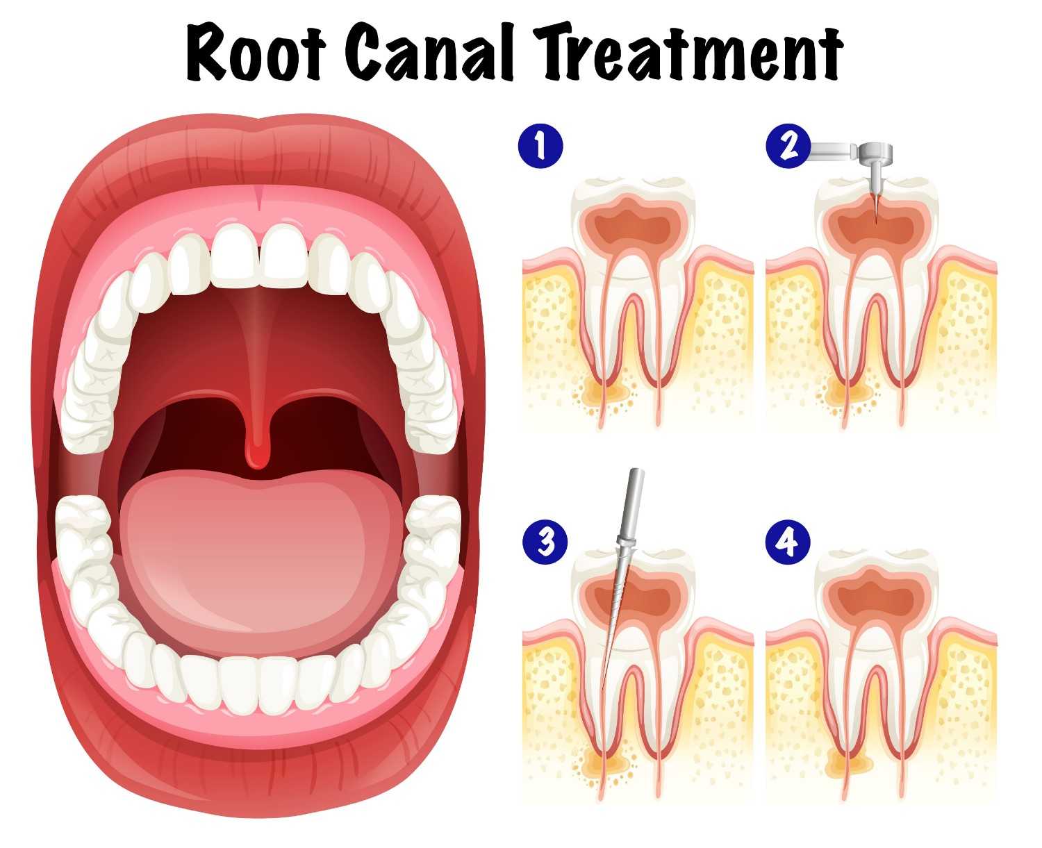 root-canal-treatment-in-karuppayurani-madurai